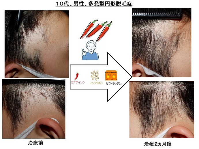 円形脱毛症　名医